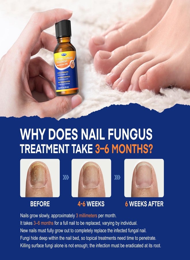 VigorWell Toenail Fungus Treatment with 25% Undecylenic Acid: Toenail Fungus Treatment Extra Strength for Thick, Yellow and Damaged Nails - Safe and Gentle for Nails Care - Image 3